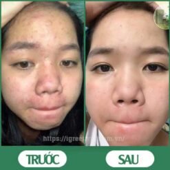 Serum trị mụn diếp cá igreen - Sạch mụn hết thâm