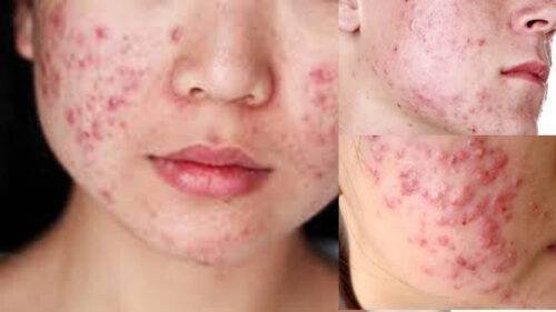 Top 1 Serum Trị Mụn