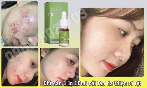 19 câu hỏi liên quan đến sản phẩm serum diếp cá igreen