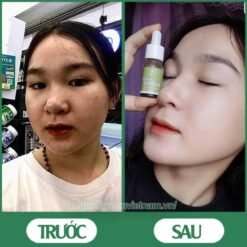 Serum trị mụn diếp cá igreen - Sạch mụn hết thâm