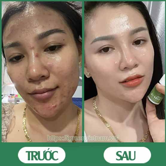 Serum trị mụn diếp cá igreen - Sạch mụn hết thâm