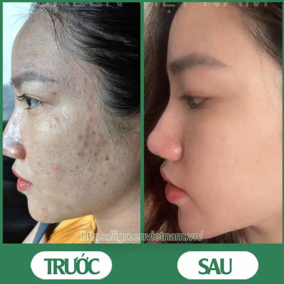 Serum trị mụn diếp cá igreen - Sạch mụn hết thâm