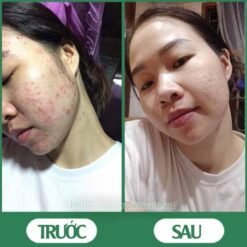 Serum trị mụn diếp cá igreen - Sạch mụn hết thâm