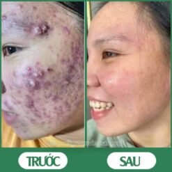 Serum trị mụn diếp cá igreen - Sạch mụn hết thâm