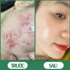 Serum trị mụn diếp cá igreen - Sạch mụn hết thâm