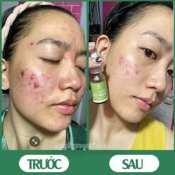 Serum trị mụn diếp cá igreen - Sạch mụn hết thâm