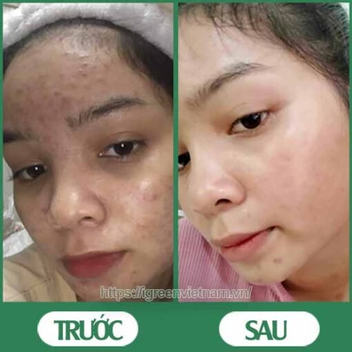 Serum trị mụn diếp cá igreen - Sạch mụn hết thâm